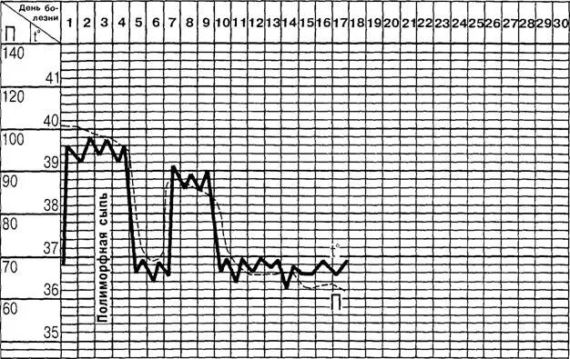 Лихорадка 4 день. Температурная кривая волнообразная лихорадка. Седловидная температурная кривая. Лихорадка Денге температурная кривая. Температурная кривая при волнообразной лихорадке.