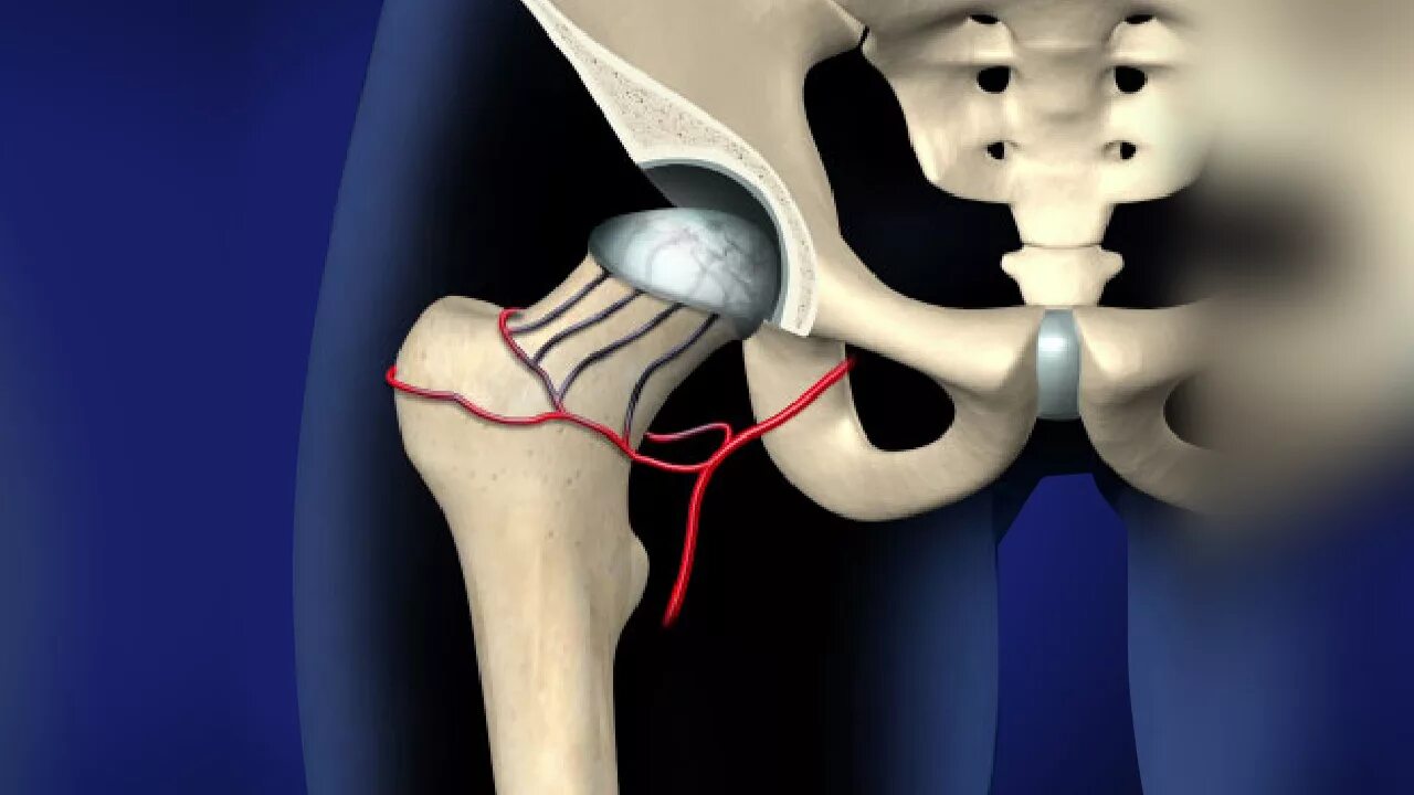 Операция тазобедренный кость