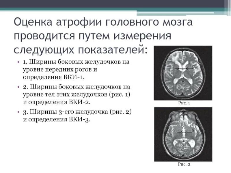 Мрт головного мозга кортикальная церебральная атрофия 1 степени. Кт признаки атрофии головного мозга. Кт признаки церебральной атрофии. Умеренные атрофические изменения головного мозга.