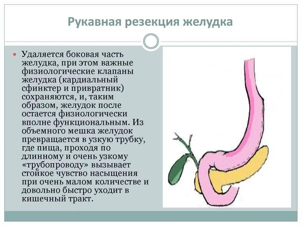 Умер от резекции желудка. Бариатрическая операция рукавная резекция желудка. После продольной резекции желудка. Резекция желудка после операции. Желудок после резекции.