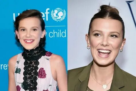 Millie Bobby Brown Plastic Surgery: Rumors, Expert Opinion & Analysis PlasticSur