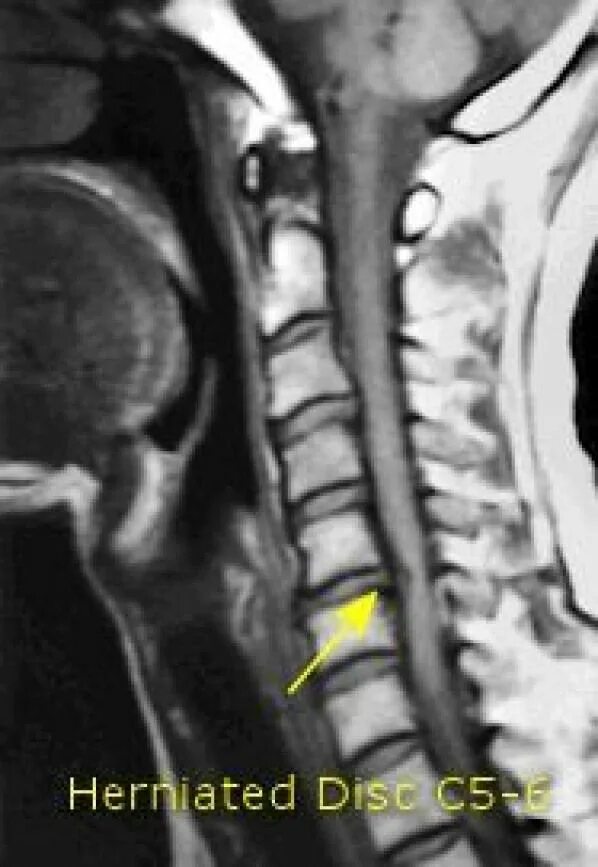 Диск c5 c6. Грыжа c5-c6 мрт. грыжа диска c5/c6. грыжа c6 c7. neck disc herniation мрт.