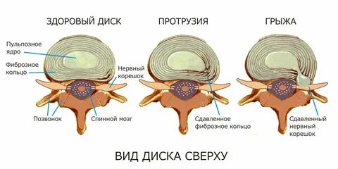 Экструзия что это в позвоночнике