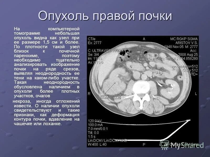 Горбатая почка. Объемные образования почек кт. Опухоль почки на кт описание.