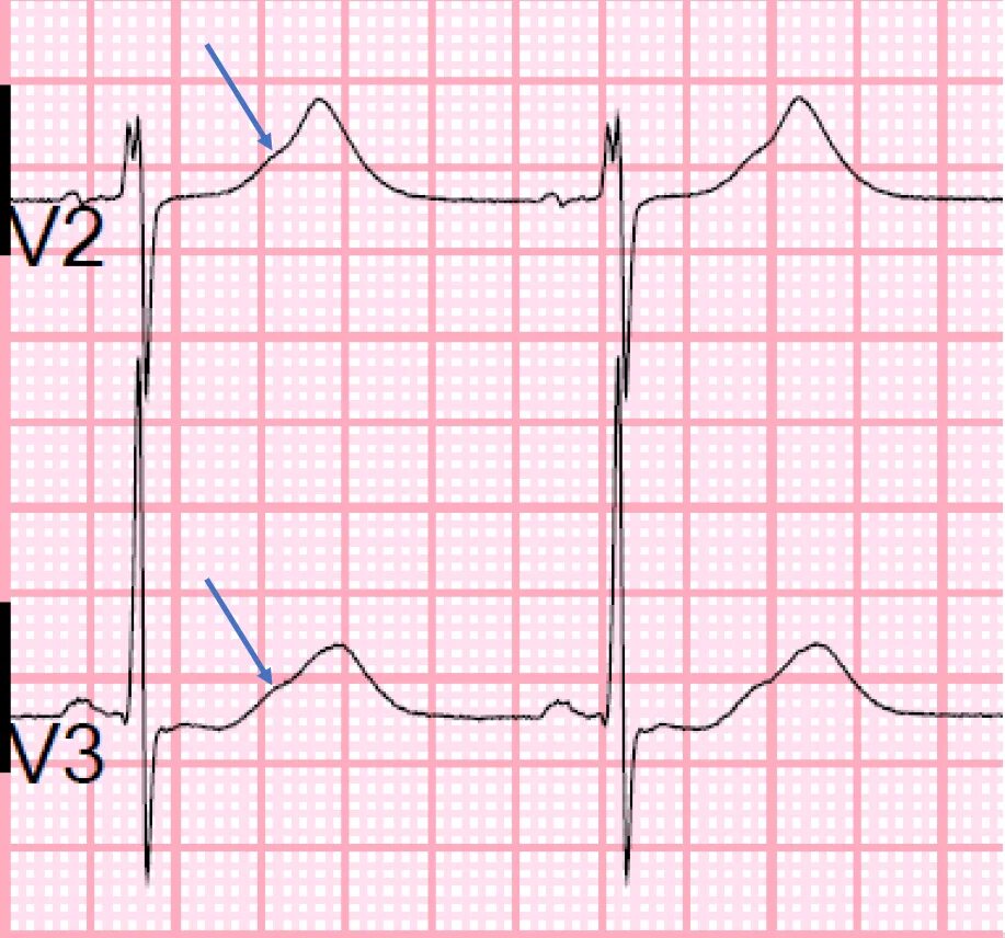 Отрицательный коронарный зубец т в v1-v3. Отрицательный зубец р на экг в v1. Avl отведение экг. Rsr rsr экг. Avl avf в экг.