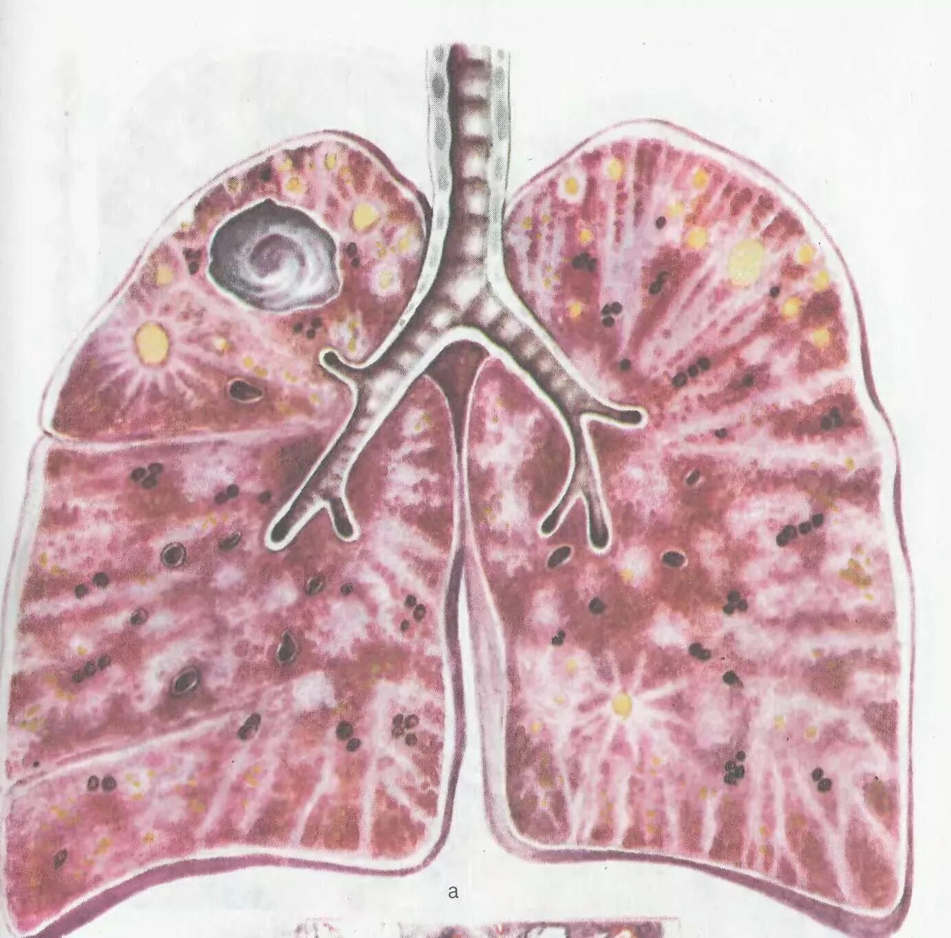 Цирротический туберкулез легких патанатомия. Легкие человека с туберкулезом