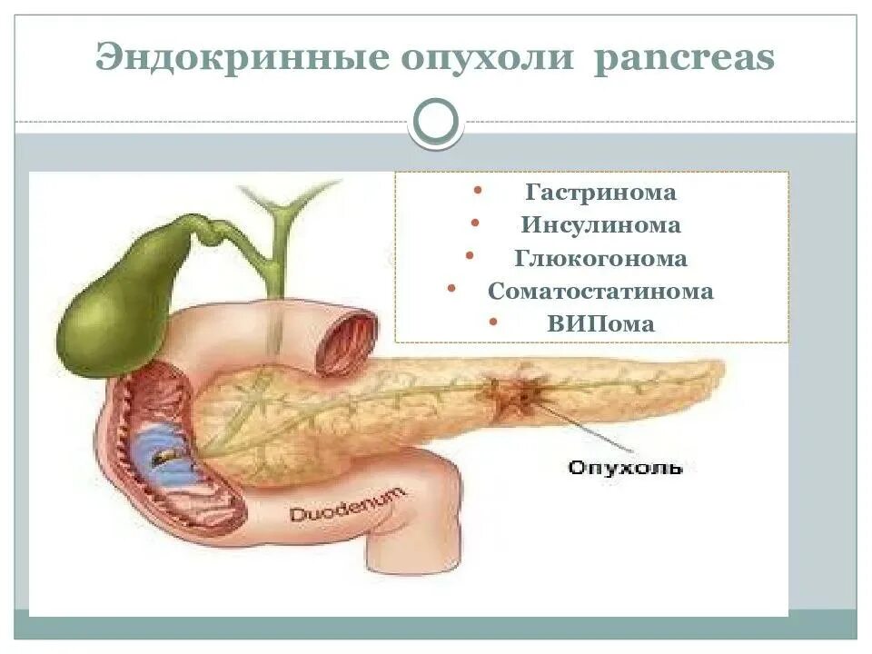 Випома поджелудочной железы. Соматостатинома поджелудочной железы. Глюкагонома поджелудочной железы. Опухоли желез внутренней секреции.