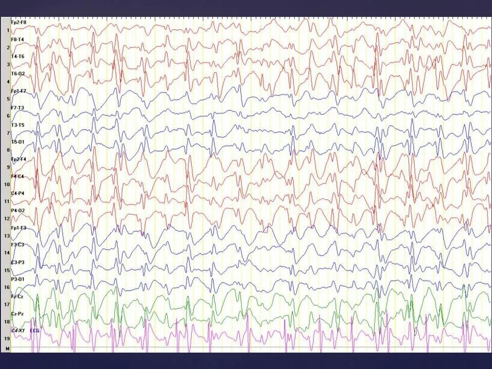 Normal abnormal. Eeg 10-20. normal eeg. шапки eeg medicom. loreta eeg.