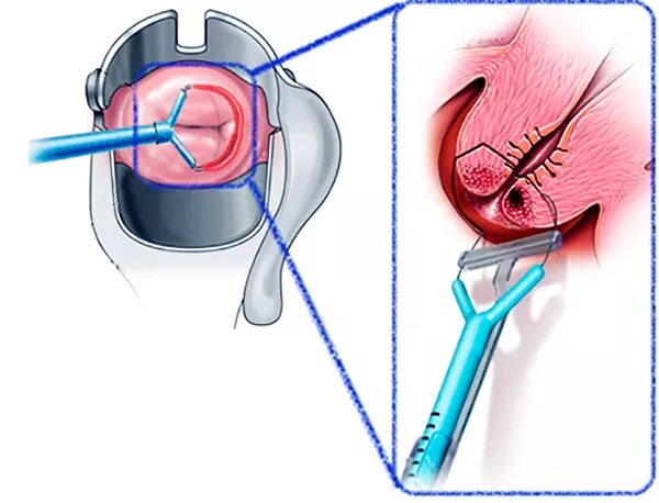 После эксцизии шейки