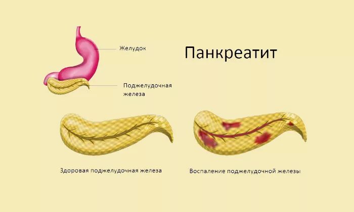 Полностью вылечил панкреатит. Что такое панкреатит поджелудочной. Больной с острым панкреатитом.