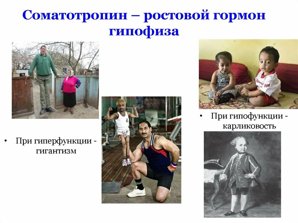 При гипофункции гипофиза развивается. Гигантизм болезнь гипофиза. соматотропин карликовость и гигантизм. гиперфункция гипофиза гигантизм. гипофункция гипофиза карликовость.