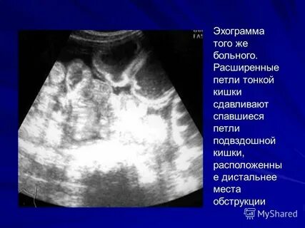 Петли кишечника раздуты на узи причины