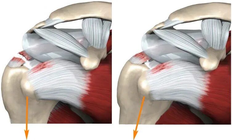 Разрыв надостного сухожилия плечевого сустава лечение