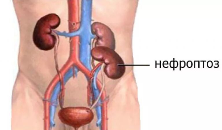Почки справа у мужчин. Нефроптоз 1 степени правой почки. Нефроптоз 3 степени правой почки. Нефроптоз 2 степени правой почки.