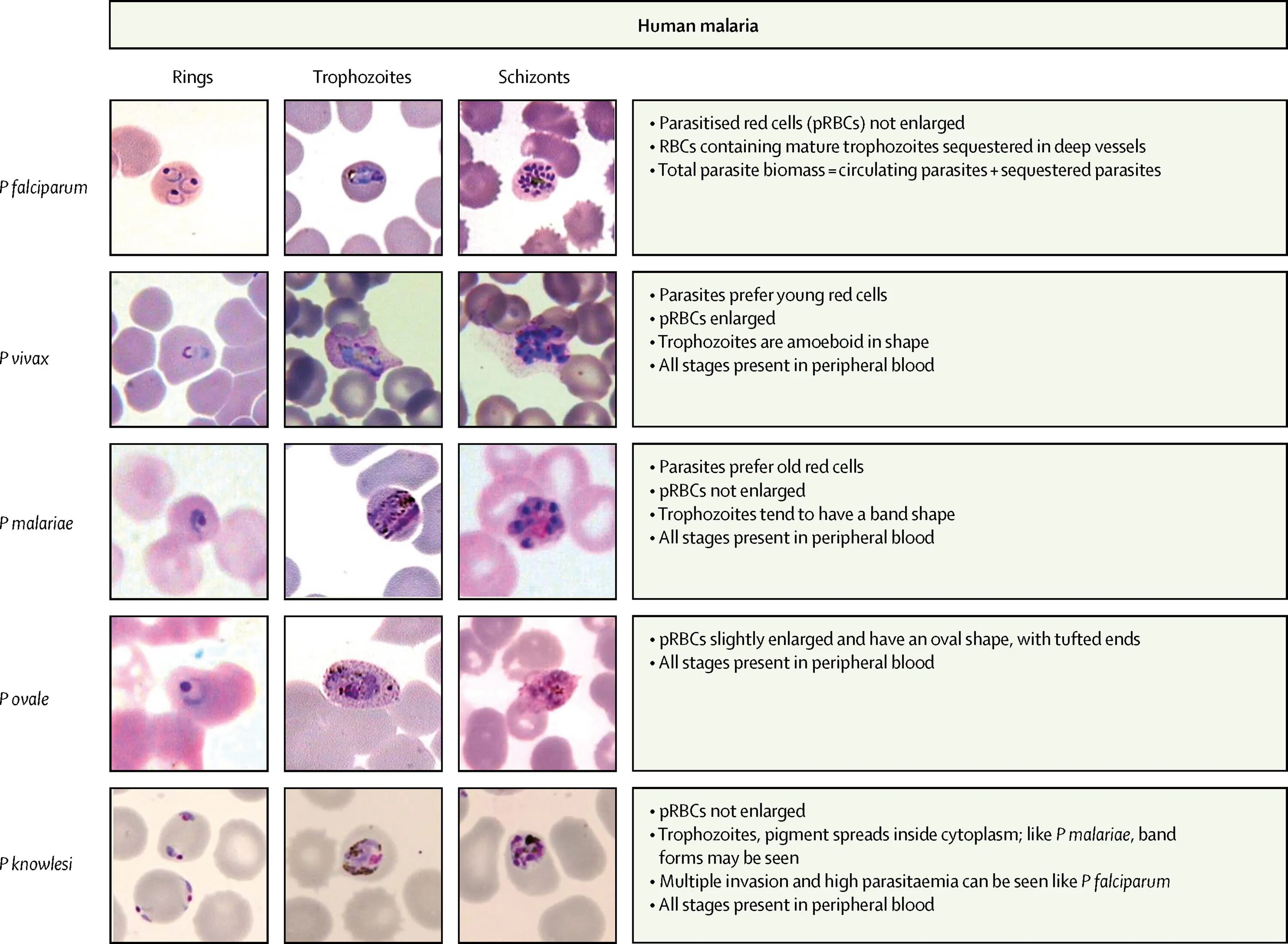 Plasmodium falciparum трофозоит. Плазмодии малярии таблица. Плазмодий Vivax. Plasmodium Vivax malaria таблица.