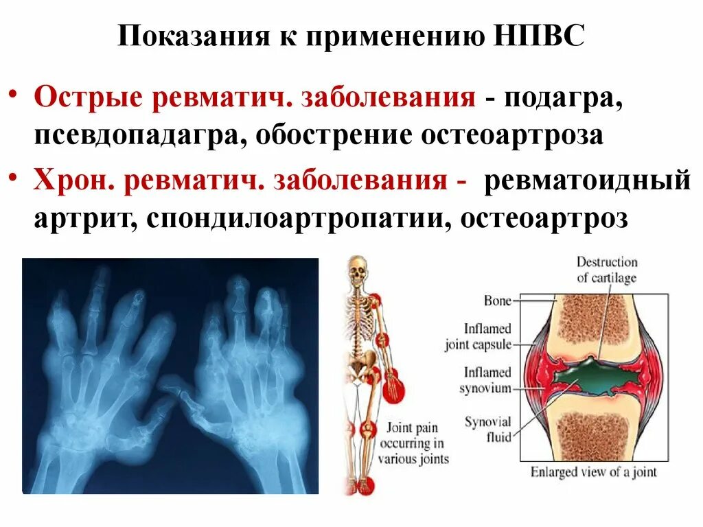 Нпвс при ревматоидном артрите