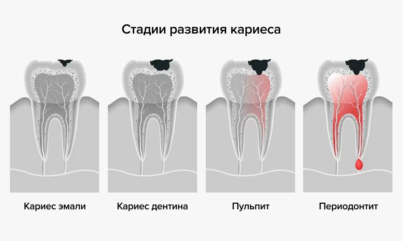 Утрачены полностью или частично. Стадии разрушения зубов. Степень разрушения зуба.