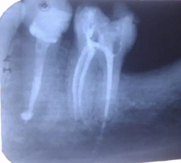 Плохо запломбированный канал. Запломбированный канал 5 зуба. Болит зуб после пломбирования каналов. Прицельный снимок запломбированного зуба.