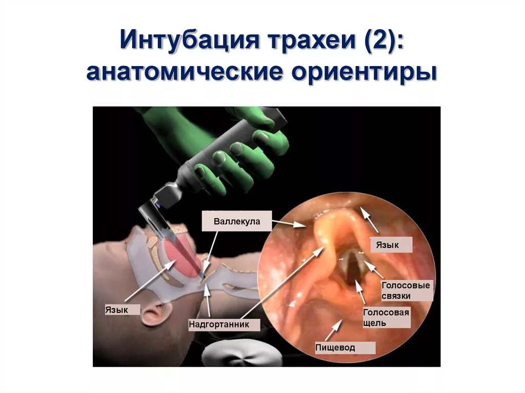 Оротрахеальная интубация. Техника интубации Ларингоскоп. Техника интубации трахеи. Трубка во время операции