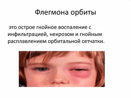 Флегмона новорожденных