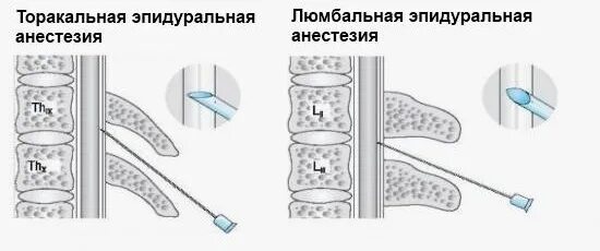 Спинальная и эпидуральная анестезия. Иголка для эпидуральная анестезия. Люмбальная эпидуральная анестезия. Торакальная эпидуральная анестезия.