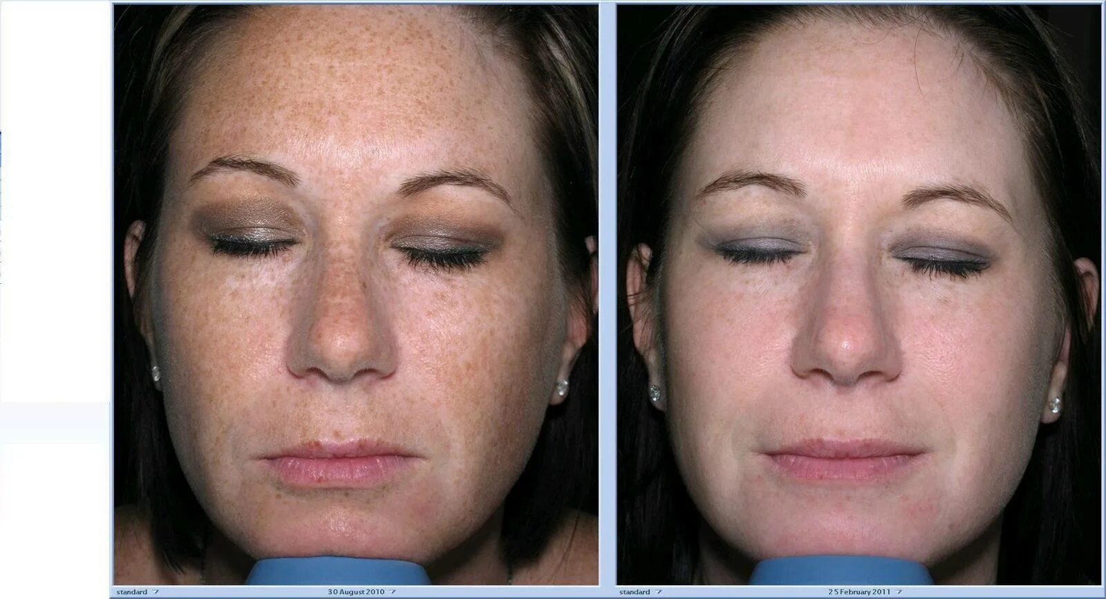 Пилинг джесснера мезолаб. Пилинг. Пилинг джесснера что это. Химический пилинг jessner. Пилинг джесснера что это.