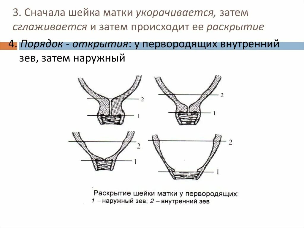 Зев шейки матки закрыт. Шейка матки при беременности незрелая. Шейка матки наружный и внутренний зев. Шейка матки внутренний зев и наружный зев. Шейка матки внутренний зев сомкнут.