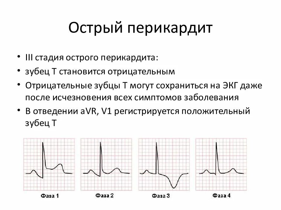 Сегмент st и зубец т. Сегмент st и зубец т