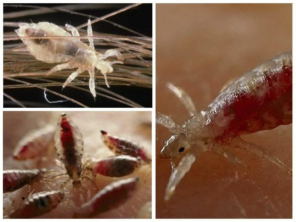 Головная вошь (pediculus humanus capitis). Платяная вошь под микроскопом. Головная вошь (pediculus humanus capitis). Фото вошей. Головная и платяная вошь под микроскопом.