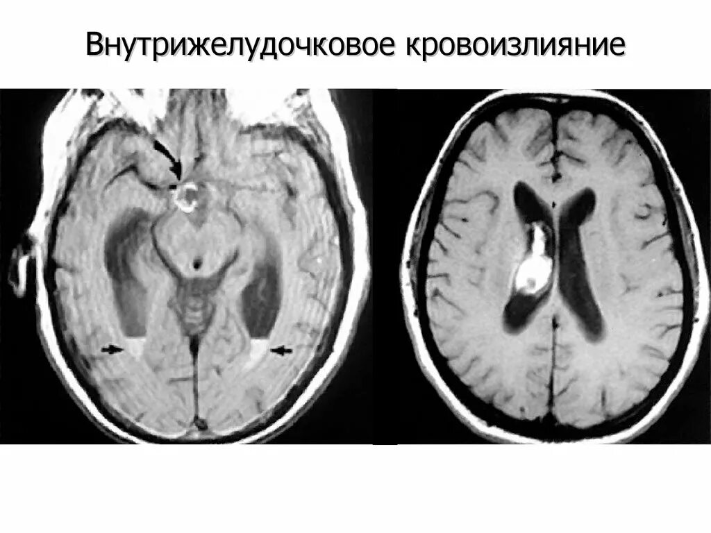 Субарахноидальный инсульт кт. Внутрижелудочковая гематома на кт. Субарахноидальное кровоизлияние макро. Субарахноидальное кровоизлияние это инсульт. Кровоизлияние в желудочки