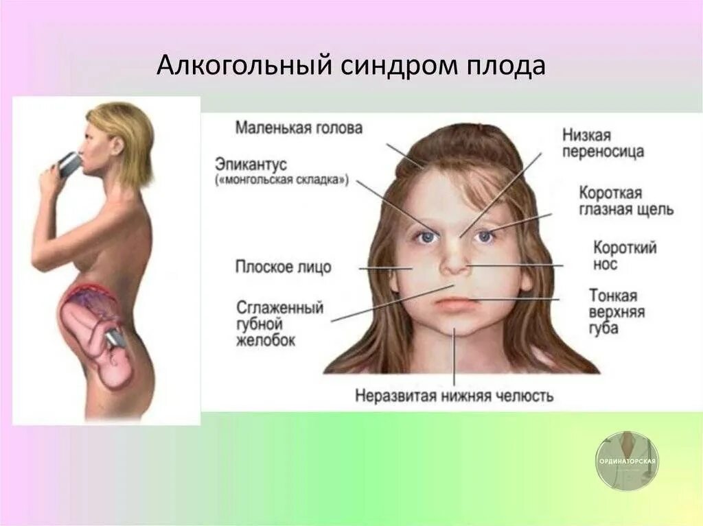 Признаки фетального алкогольного. Симптомы алкогольного синдрома плода. Фетальный алкогольный синдром плода. Фетальный алкогольный синдром у детей внешние признаки. Синдром алкоголь фетальный алкогольный.