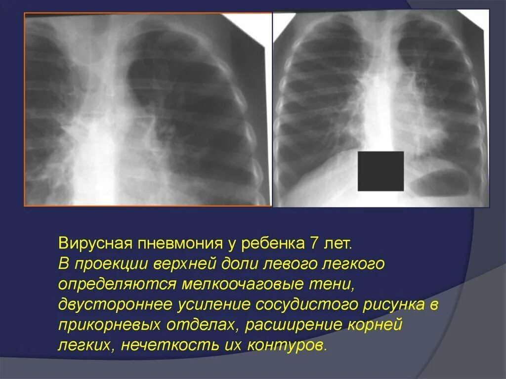 Инфильтративный туберкулез легких рентген. Усиление сосудистого рисунка легких. Усиление легочного сосудистого рисунка. Усиленный сосудистый рисунок легких.