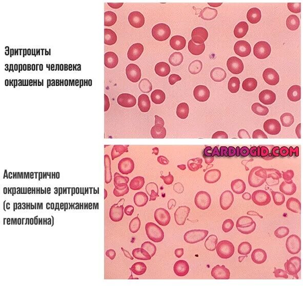 Анемия и эритроциты в крови. Анемии вследствие разрушения эритроцитов. Гипохромная микроцитарная анемия клиника. Сидеробластная анемия эритроциты. Сидеробластная анемия мазок крови.