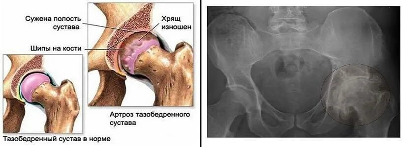 Можно ли лечить тазобедренный сустав. Артроза тазобедренного сустава коксартроза. тазобедренный артроз 1 стадия. коксо артроз бедренного сустава симптомы. деформирующий артроз коксартроз.
