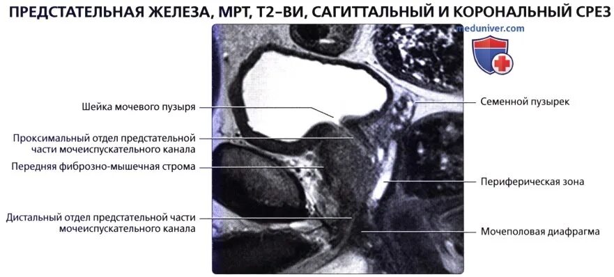 Карцинома мрт предстательной железы. Предстательная железа мрт сагитал. Зоны предстательной железы мрт. Анатомия семенных пузырьков мрт. Предстательная железа включения