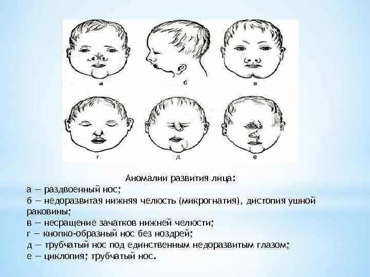 Аномалии развития называются. Врожденные пороки развития лица и шеи причины. Рожденные пороки развития лица. Врожденные патологии лица.