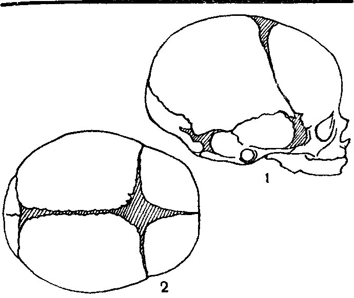 Роднички черепа анатомия. Роднички у новорожденных анатомия. Роднички черепа новорожденного. Роднички у новорожденных анатомия рисунок. Кости родничков