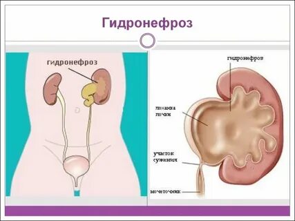 Гидронефроз почек код мкб