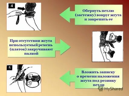 Способ остановки артериального давления
