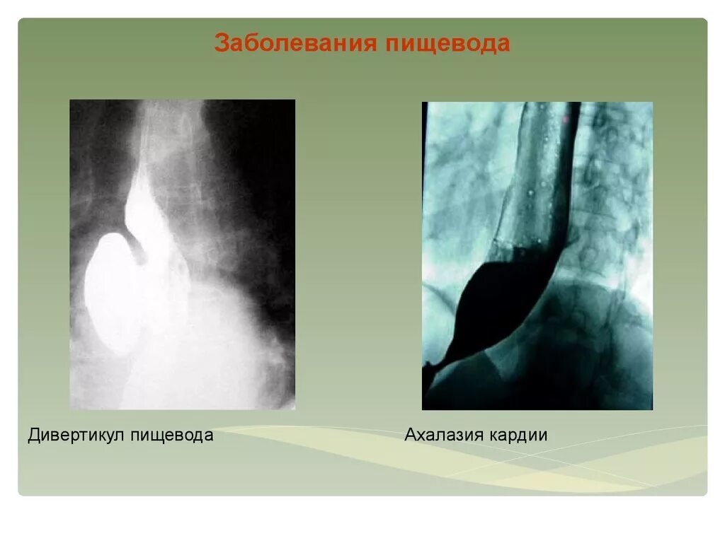 Ахалазия пищевода на рентгенограмме. Недостаточность кардии ГЭРБ. Стеноз пищевода рентген. ГЭРБ стриктура пищевода. Нарушение пищевода