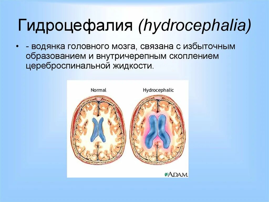 Выраженная заместительная гидроцефалия. Внутренняя гидроцефалия головного. Внутренняя водянка головного мозга. Обтурационная гидроцефалия.