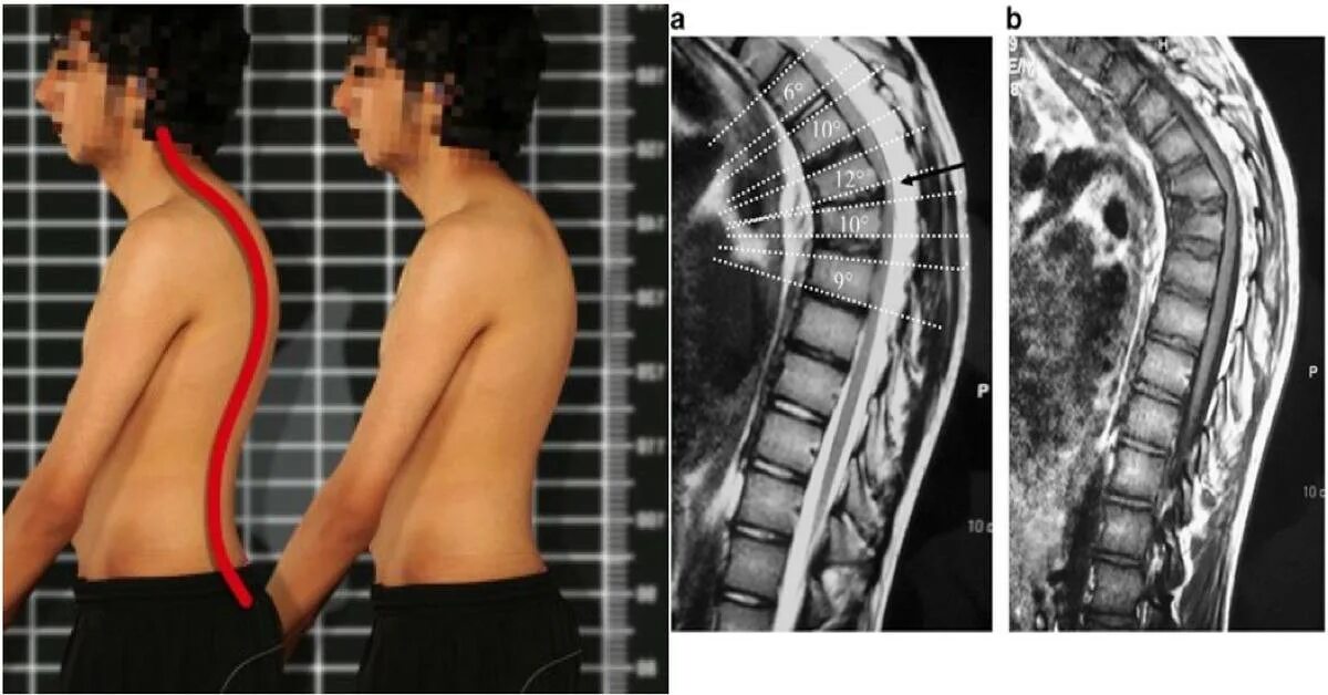 Болезнь Шейермана МАУ мрт. Кифосколиоз (болезнь Шейермана-МАУ).