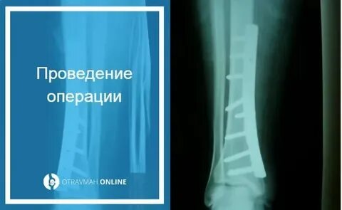 Через сколько операция перелом