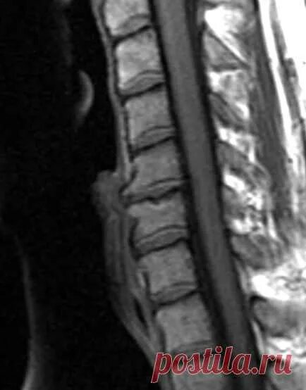 Дегенеративно дистрофические изменения дисков l5 s1. Диски c5 c6 межпозвонковые. остеофиты на мрт позвоночника. дегенеративно-дистрофические изменения позвоночника мрт. остеофиты шейного отдела на мрт.