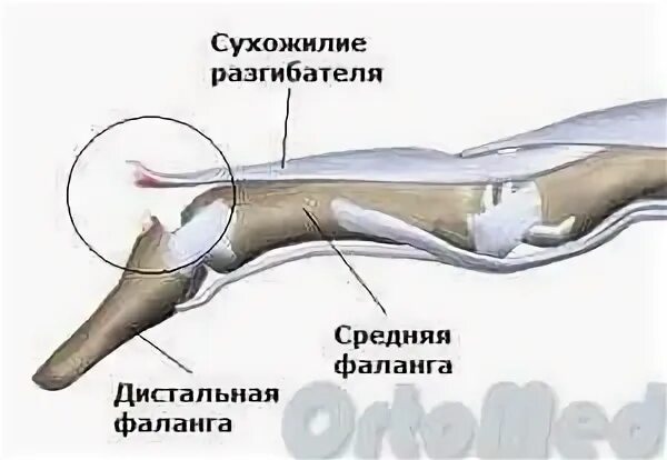 Разрыв сухожилия разгибателя кисти. Разрыв разгибателя пальца фаланги. разрыв сухожилия разгибателя пальца кисти. отрыв сухожилия разгибателя пальца операция. разрыв сухожилия дистальный межфаланговый сустав.