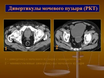 Кт мочевого пузыря