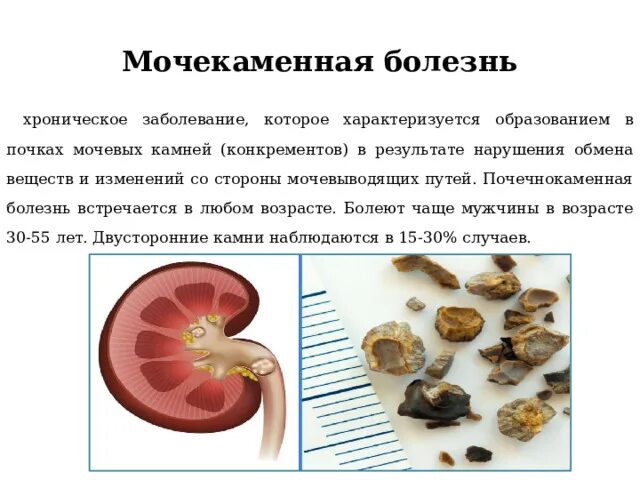 Пиелонефрит и мочекаменная болезнь. Стенд в почку при мочекаменной болезни. Мочекаменная болезнь у птиц. Мочекаменная болезнь прогрессирует.