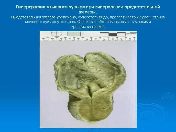 Что такое диффузная гиперплазия предстательной. Что такое диффузная гиперплазия предстательной