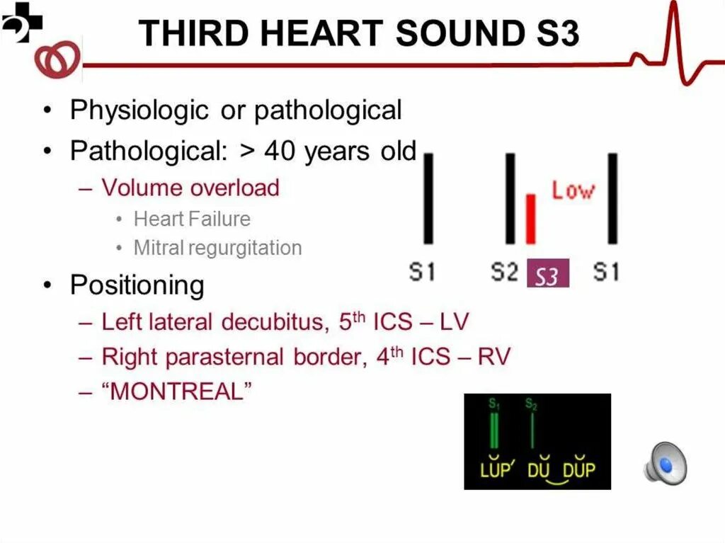 S3 Heart Sound. Sound s. S3 vs s4 Sound Cardiac. Physiological s3 Heart Sound. Three sound