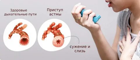 Бронхоспазм у детей